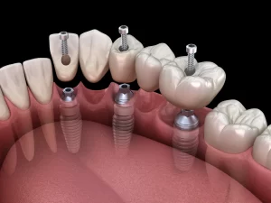 Implanty zębów cała szczęka Szczecin