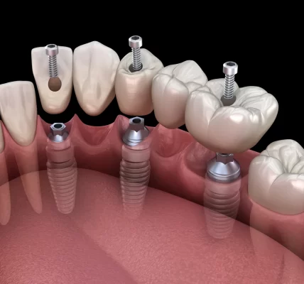 Implanty zębów cała szczęka Szczecin
