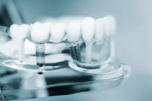 Dentysta Szczecin implanty