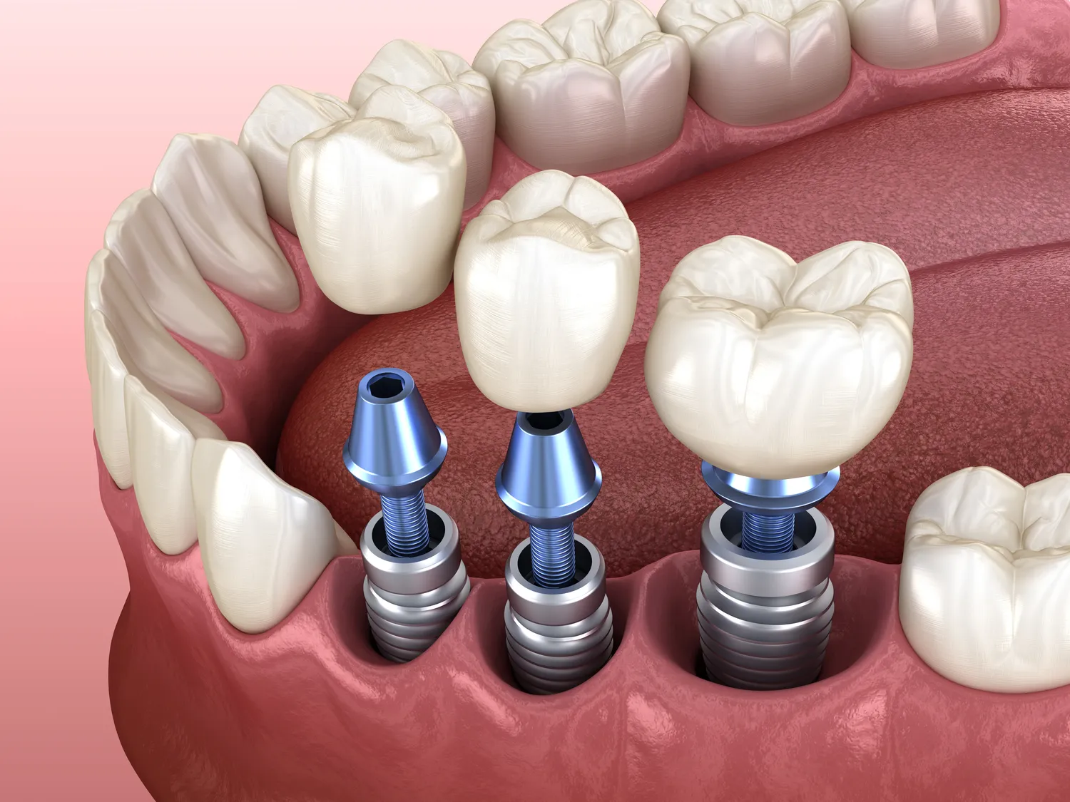 Implanty dentystyczne Szczecin